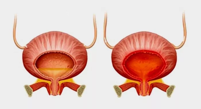 Φυσιολογική κύστη (αριστερά) και φλεγμονή της κύστης με κυστίτιδα (δεξιά)